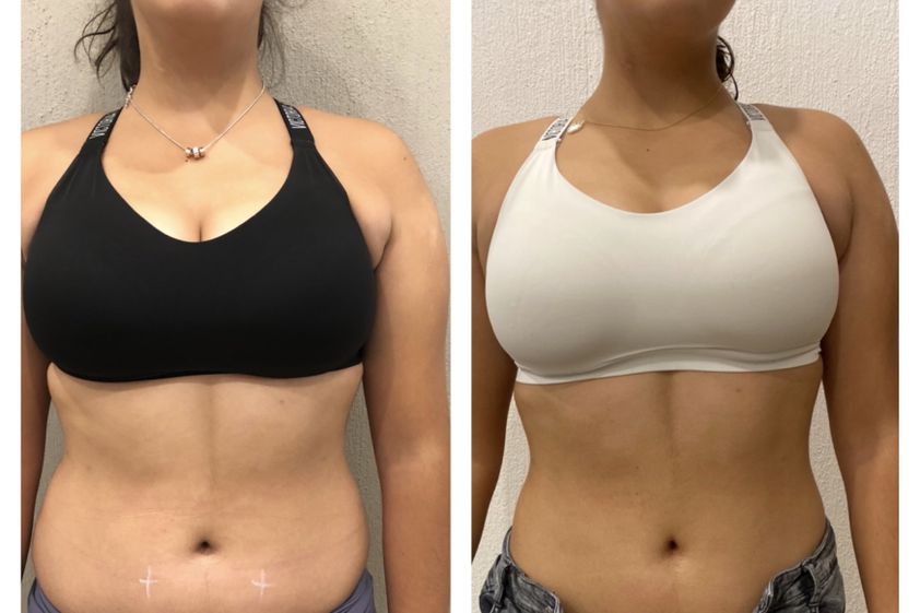 Mesoterapia antes y después - 646731