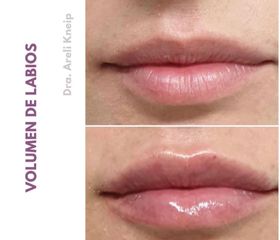 Antes y después de Aumento labios