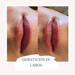Antes y después de Ácido hialurónico 