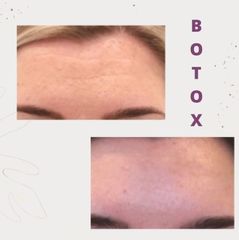 Antes y después de toxina botulínica
