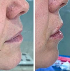 Aumento de labios - Dra. Areli Kneip