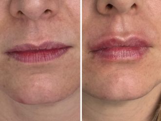 Aumento de labios antes y después - 878632