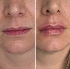Volumen de labios - Dra. Areli Kneip