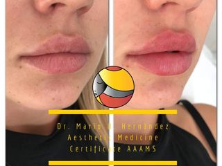 Antes y después de aumento de labios