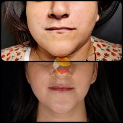 Antes y después de aumento de labios 