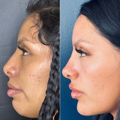 Armonización Facial