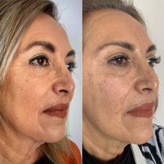 Rejuvenecimiento facial