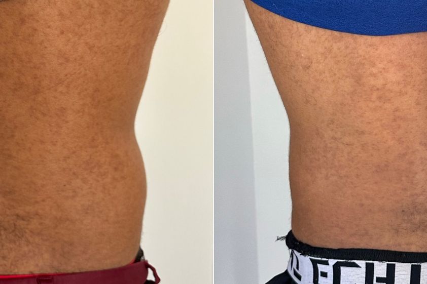 Tratamientos anticelulíticos antes y después - 870291