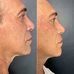 Rejuvenecimiento facial masculino