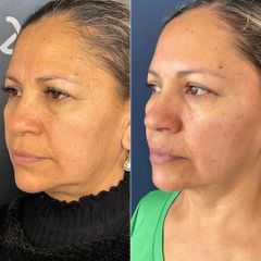 Rejuvenecimiento / armonización facial