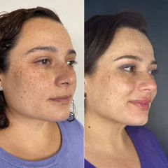 Armonización facial