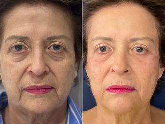 Tratamientos faciales antes y después - 870296