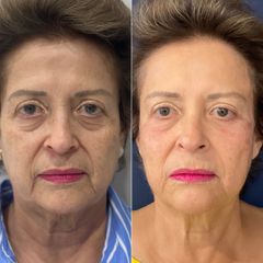 Rejuvenecimiento facial