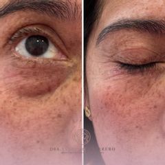 Ojeras - Dra. Asereth Guerrero