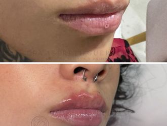 Aumento de labios antes y después - 880713