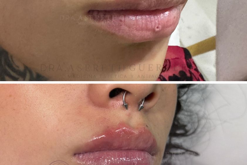 Aumento de labios antes y después - 880713
