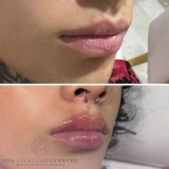 Full lips - Dra. Asereth Guerrero