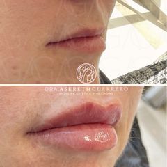 Reconstrucción labios - Dra. Asereth Guerrero