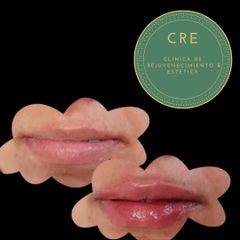 Aumento de labios - CRE