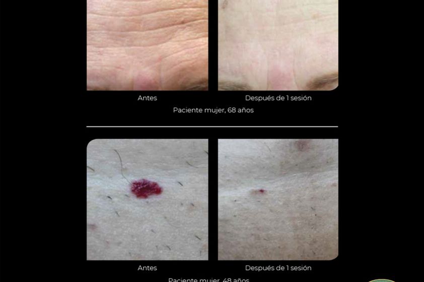 Radiofrecuencia antes y después - 867180