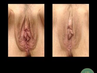 Rejuvenecimiento Vaginal antes y después - 867338