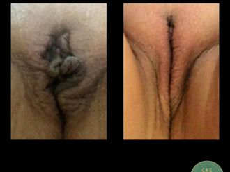 Rejuvenecimiento Vaginal antes y después - 867339