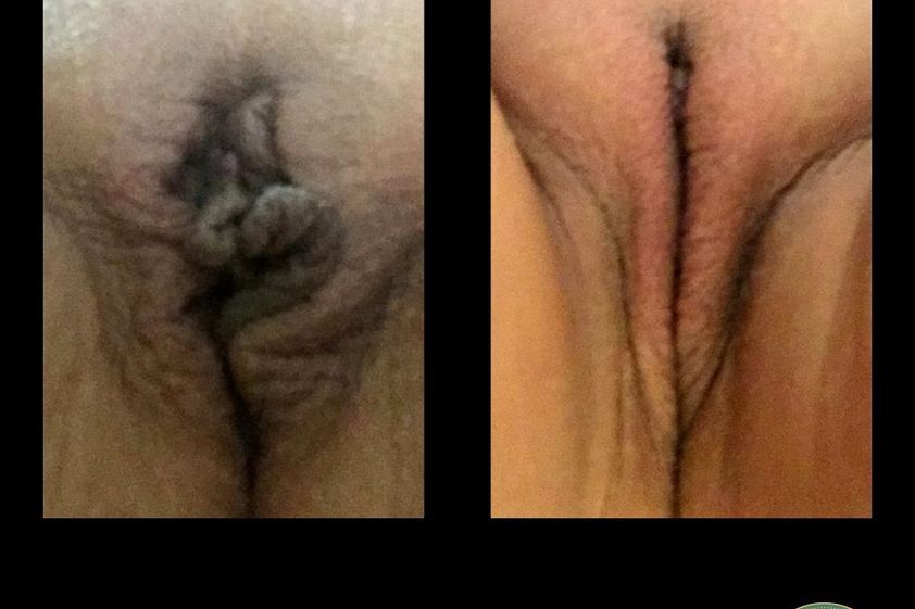 Rejuvenecimiento Vaginal antes y después - 867339