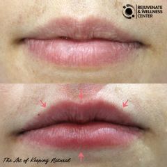 Antes y después de un aumento de labios