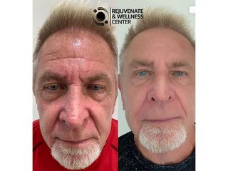 Antes y después de un rejuvenecimiento facial 