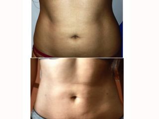 Antes y después Liposucción 