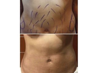 Antes y después Liposucción