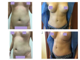 Antes y después Abdominoplastia y aumento de busto
