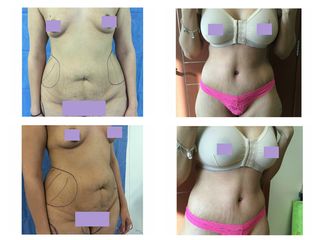 Antes y después Abdominoplastia y aumento de busto