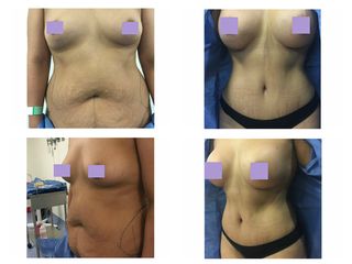 Antes y después Abdominoplastia y aumento de busto