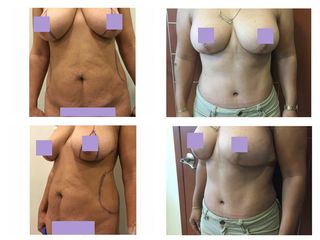 Antes y después Abdominoplastia y mastopexia