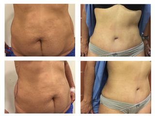 Antes y después Abdominoplastia