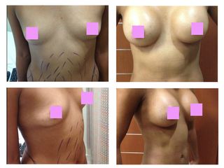 Antes y después Aumento de busto con liposucción