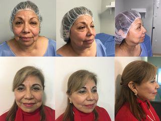 Antes y después Rejuvenecimiento Facial