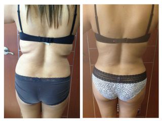 Antes y después Lipoescultura