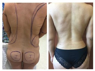 Antes y después Lipoescultura