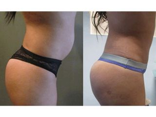 Antes y después de Abdominoplastia