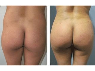 Antes y después de Lipotransferencia