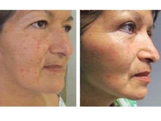 Antes y después de Lifting Facial 