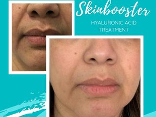Antes y después de Skinbooster / Ácido hialurónico