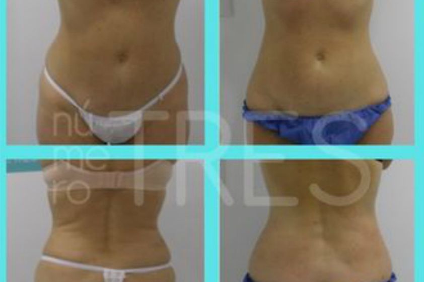 Criolipólisis antes y después - 638134