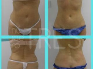 Antes y después de Crio Terapia