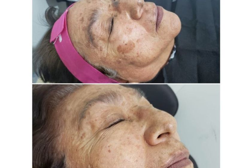 Plasma Rico en Plaquetas antes y después - 639560