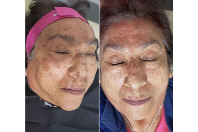 Plasma Rico en Plaquetas antes y después - 639561