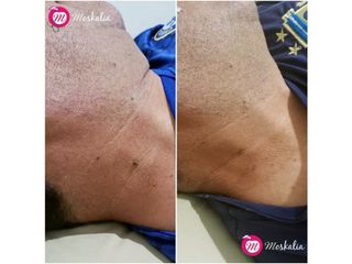Antes y después de Eliminación de verrugas