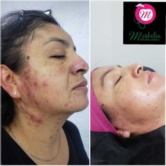 Antes y después de Tratamiento anti acné 